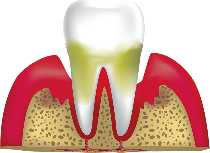 advanced periodontitis Lafayette IN