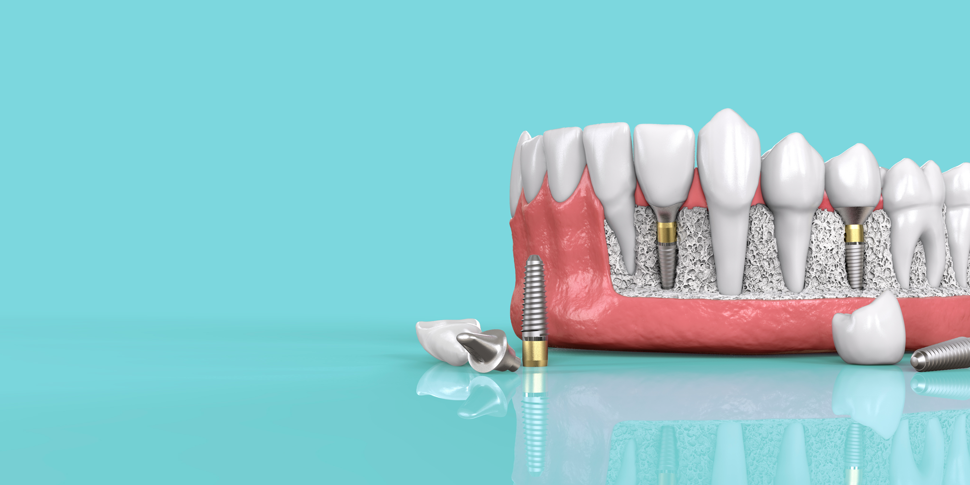 dental implant model Lafayette IN